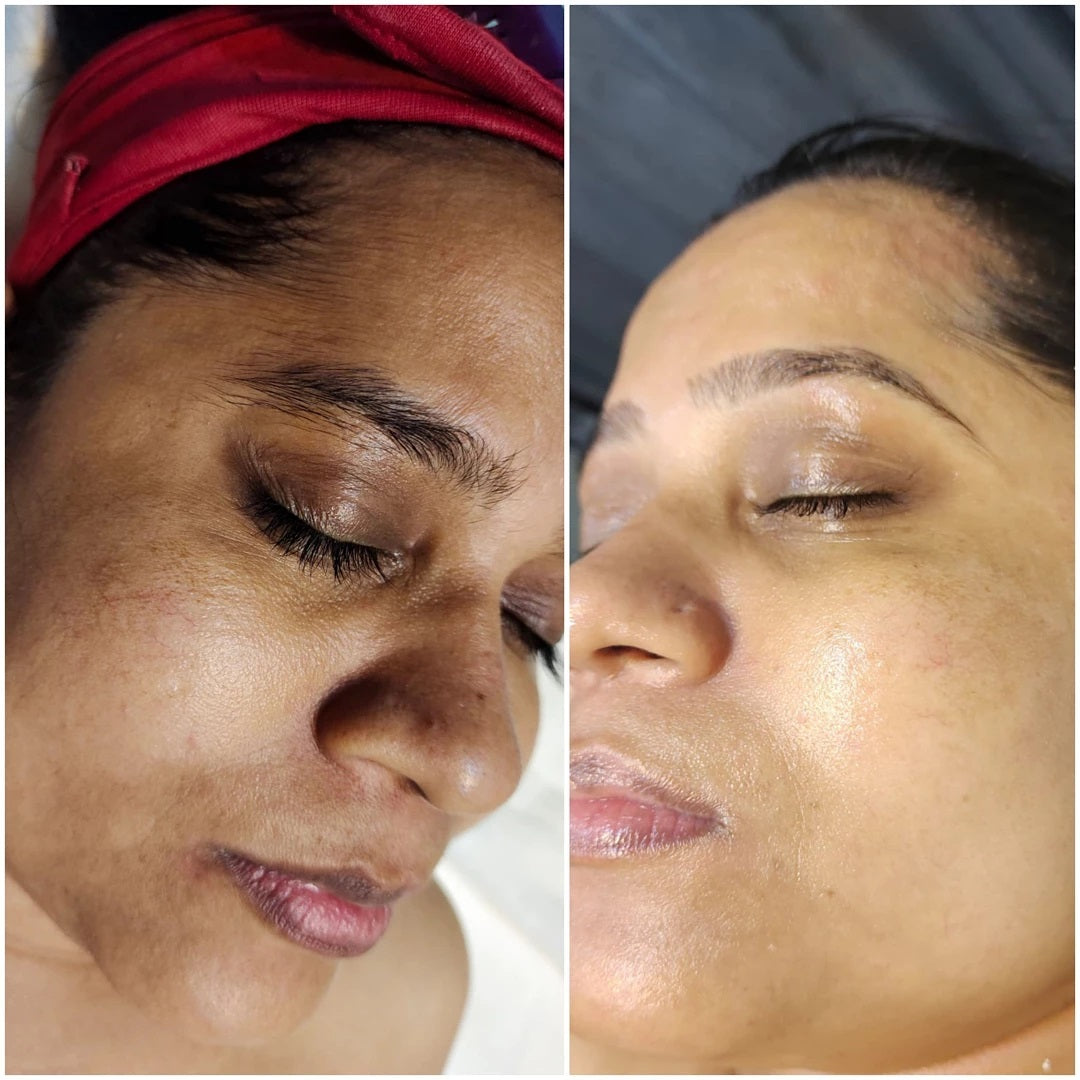 (🔥LAST DAY SALE-80% OFF)Fast Dark Spot Remover-AQA™ Melanin Correcting Facial Serum