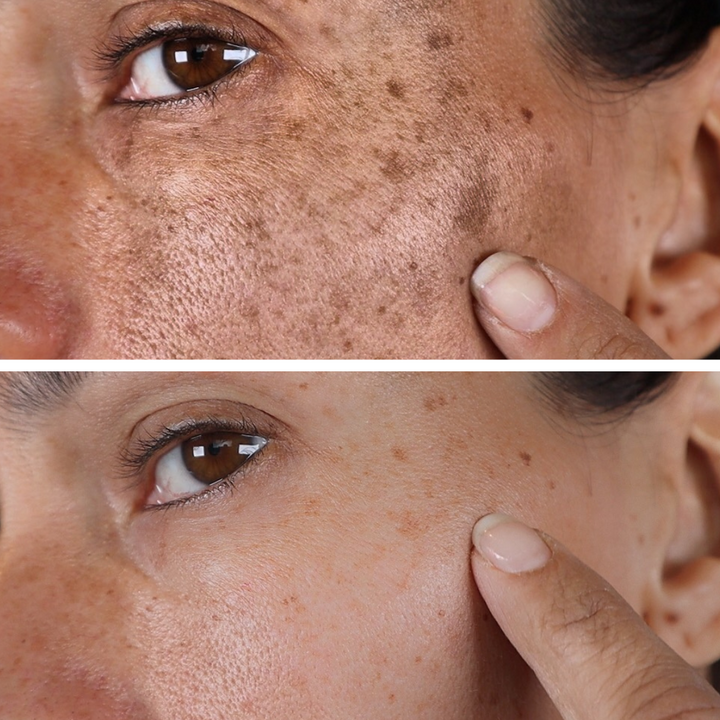 (🔥LAST DAY SALE-80% OFF)Fast Dark Spot Remover-AQA™ Melanin Correcting Facial Serum