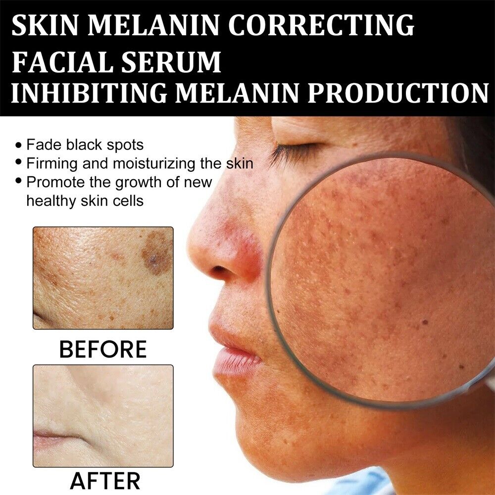 (🔥LAST DAY SALE-80% OFF)Fast Dark Spot Remover-AQA™ Melanin Correcting Facial Serum